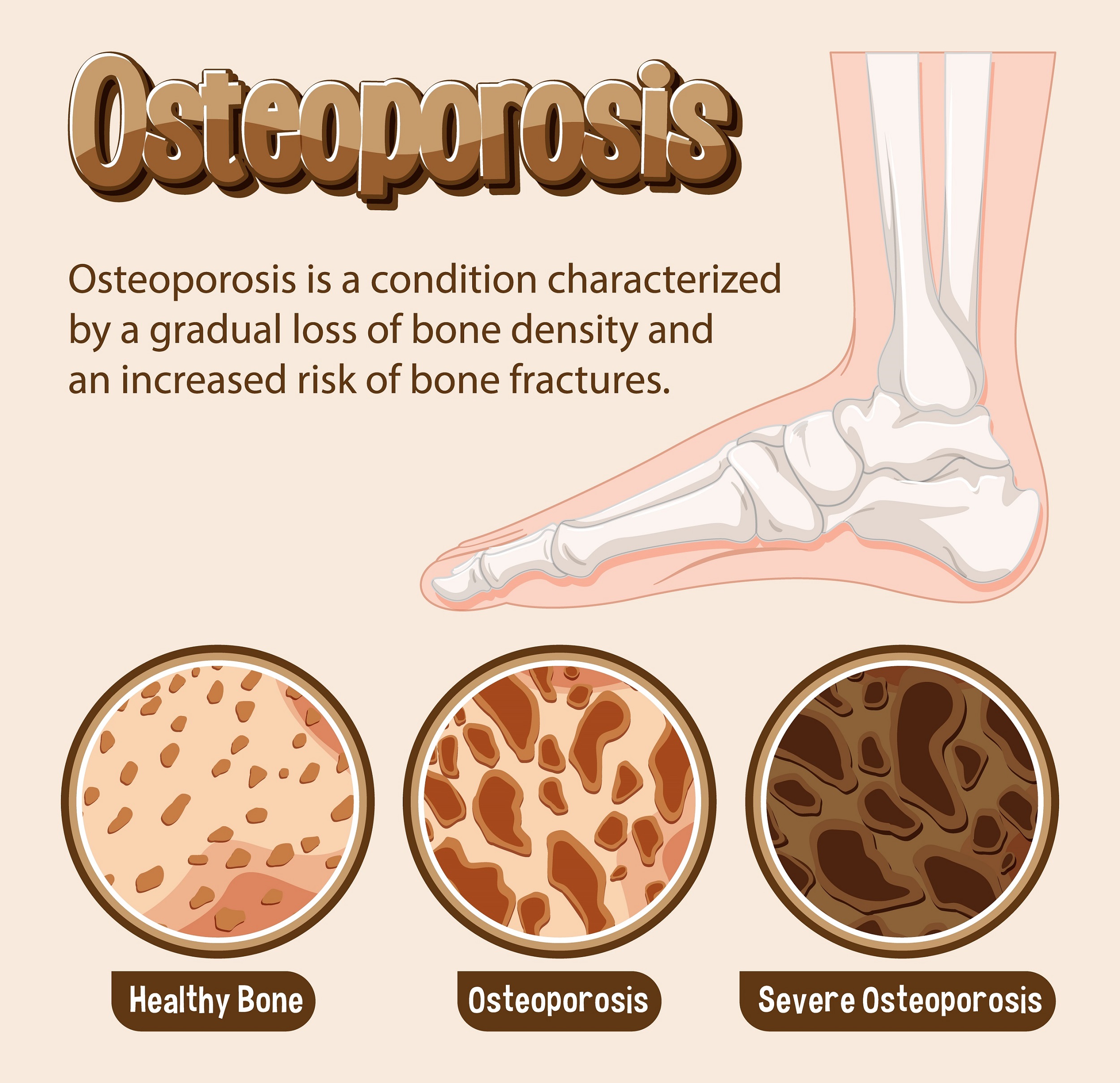 Osteoporosis